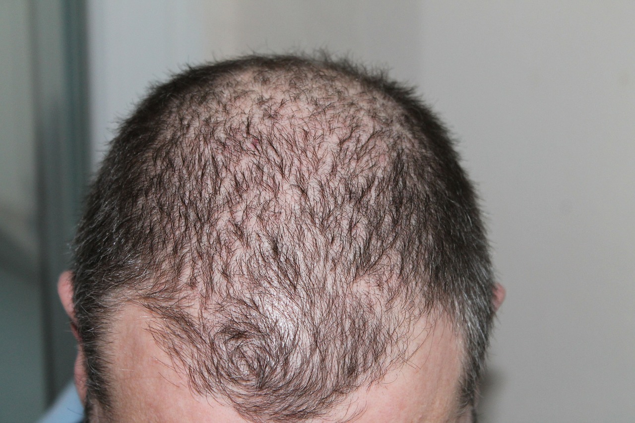 hair regrowth system